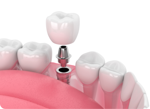 All-On-6 Dental Implants