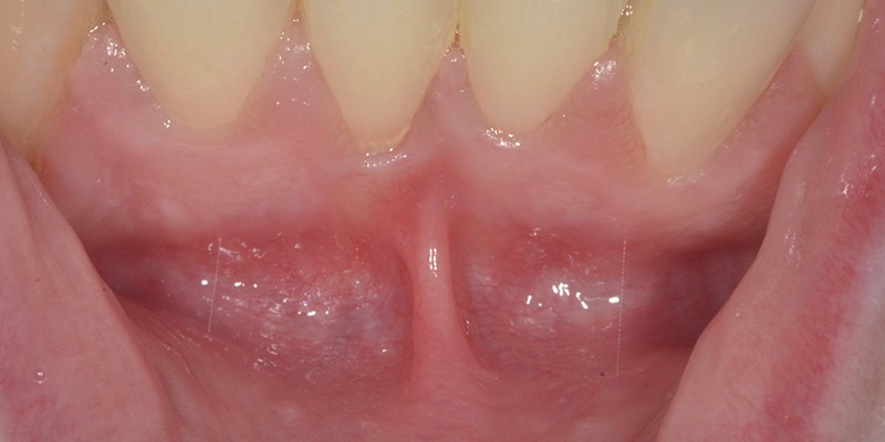 Frenectomy Auburn WA Frenectomy For Adults NuttallSmiles