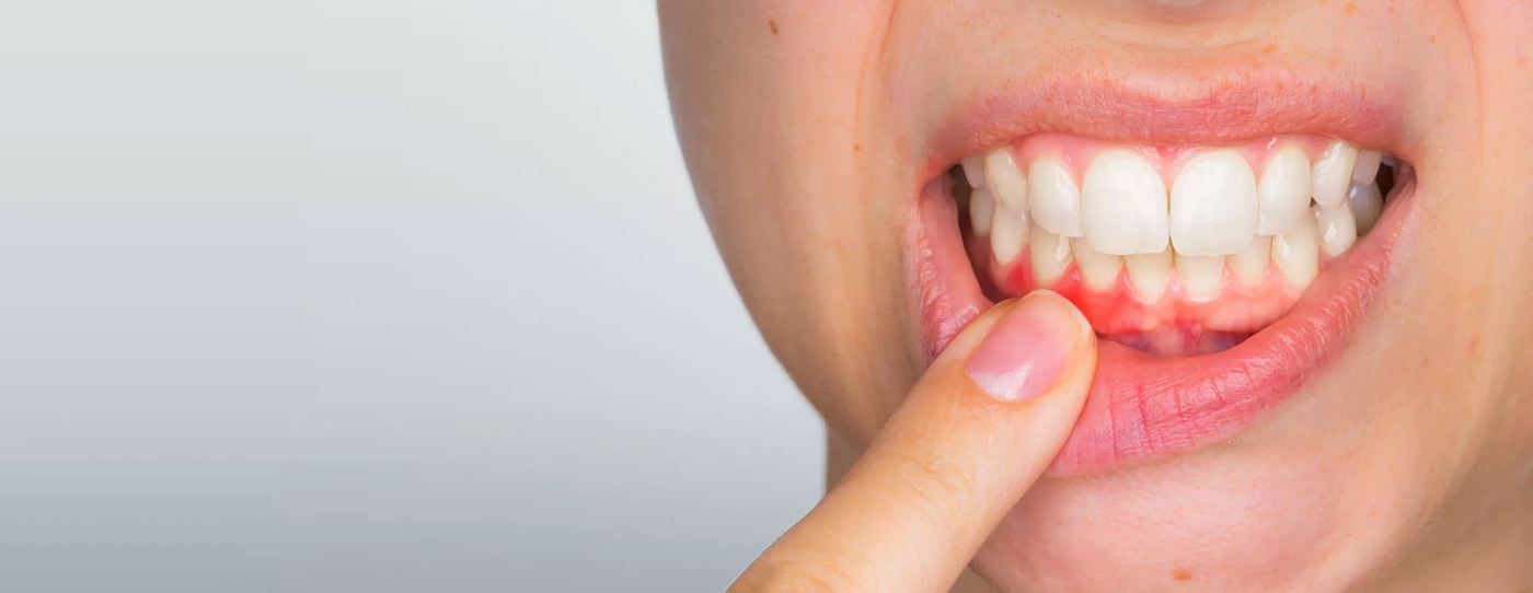 periodontal-disease-treatment