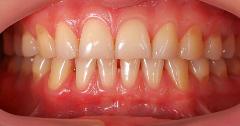 periodontal disease treatment