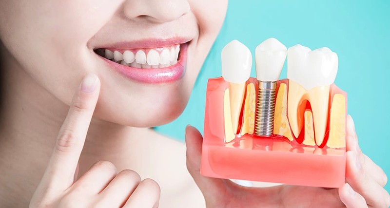 dental implants