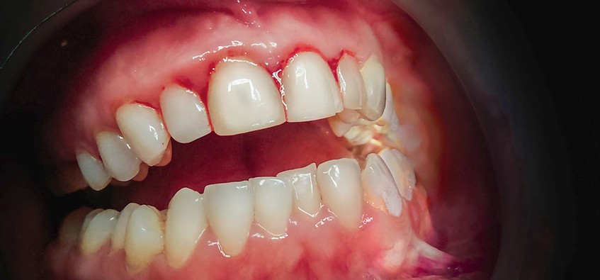 periodontal disease treatment