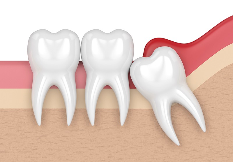 wisdom teeth removal