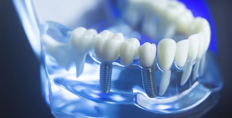 dental implants