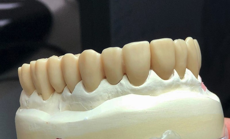 diagnostic wax up tooth models