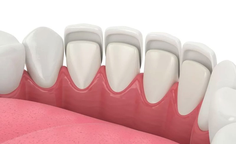 dental veneers