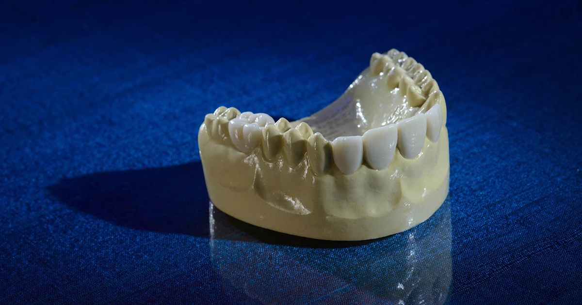 Diagnostic Wax Up Tooth Models NuttallSmiles